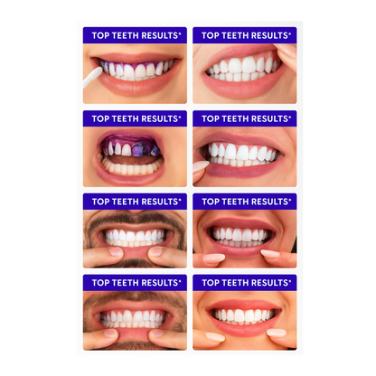 PurpleSmile™ Teeth Whitening Strips